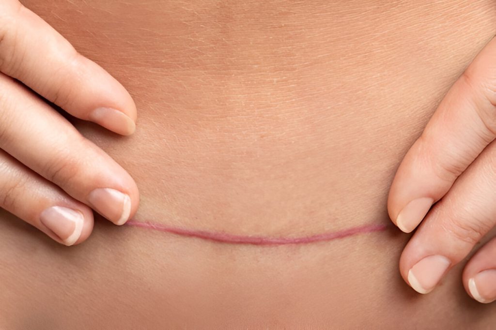 Why Does My C Section Scar Itch: Causes, Treatment, and Prevention