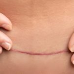 Why Does My C Section Scar Itch: Causes, Treatment, and Prevention