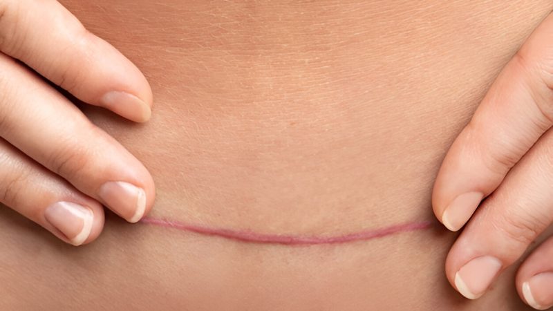 Why Does My C Section Scar Itch: Causes, Treatment, and Prevention